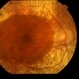 Macula Spared Advanced Retinitis Pigmentosa 8 Macula Spared Advanced Retinitis Pigmentosa 8